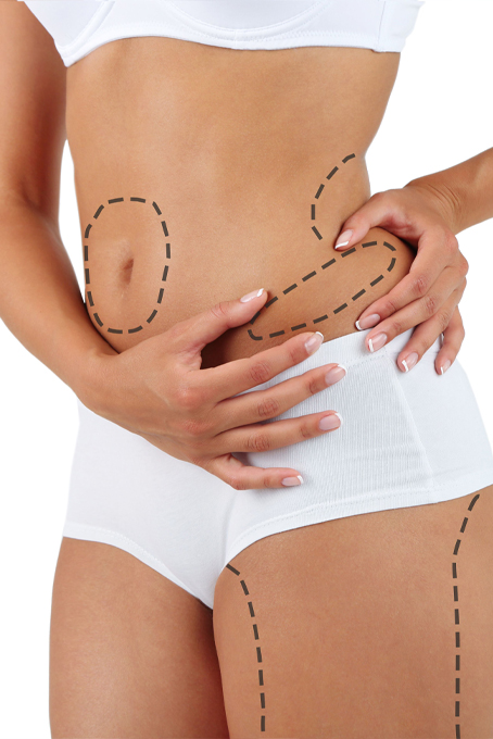 Liposuction (Yağ Aldırma)