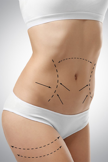 Tummy Tuck (Karın Germe)